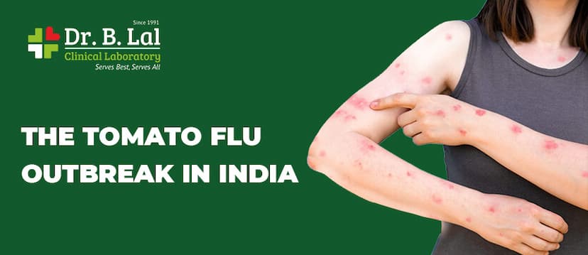 The Tomato Flu Outbreak in India