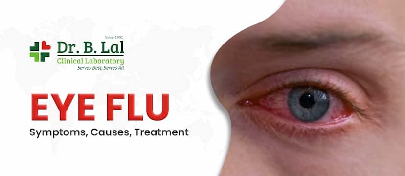 Eye Flu - Symptoms, Causes  and Treatment